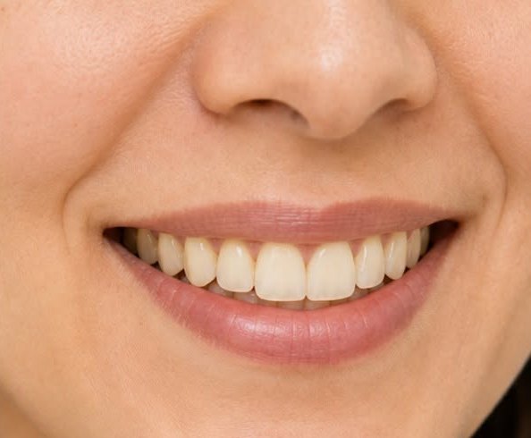 Sonrisa antes del tratamiento estético dental