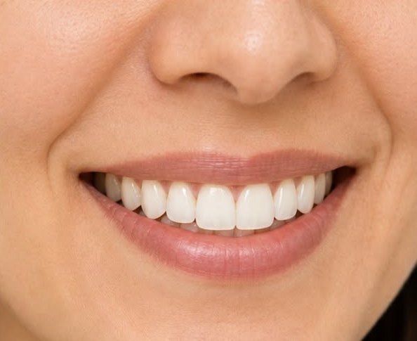 Sonrisa después del tratamiento estético dental