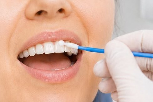 Aplicación de barniz de flúor en tratamiento dental